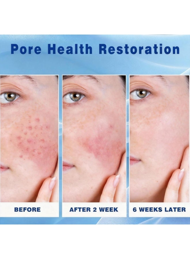 Kormesic 20% كريم حمض الزوليك للبثور كريم حمض الزوليك للوجه عالي الجودة، تجميل، يمنع الانتفاخات، يخفف البثور، يوضح البشرة، يهدئ التهيج - Image 3